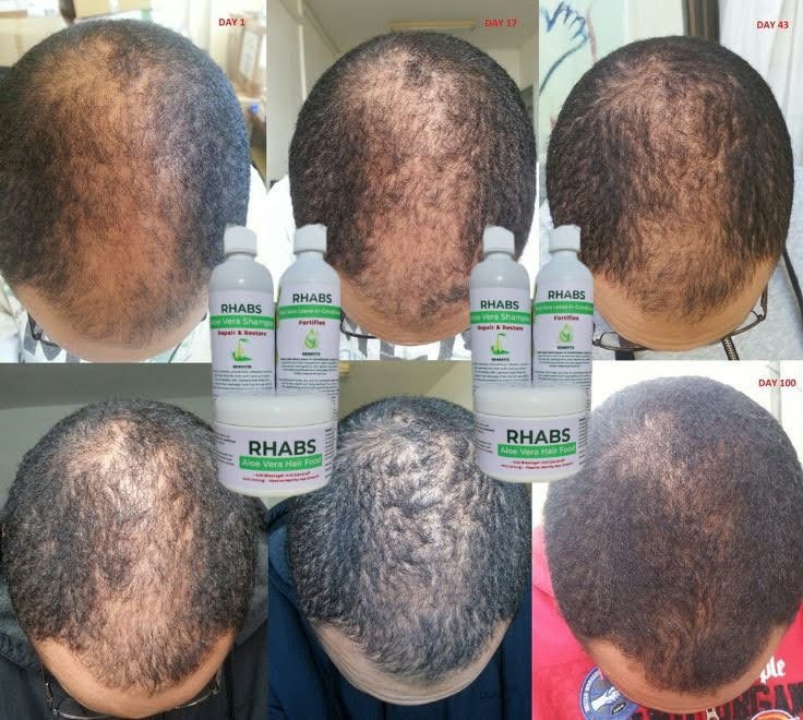 Rhabs Aloe Vera Hair Growth (Baldness Set) in GH